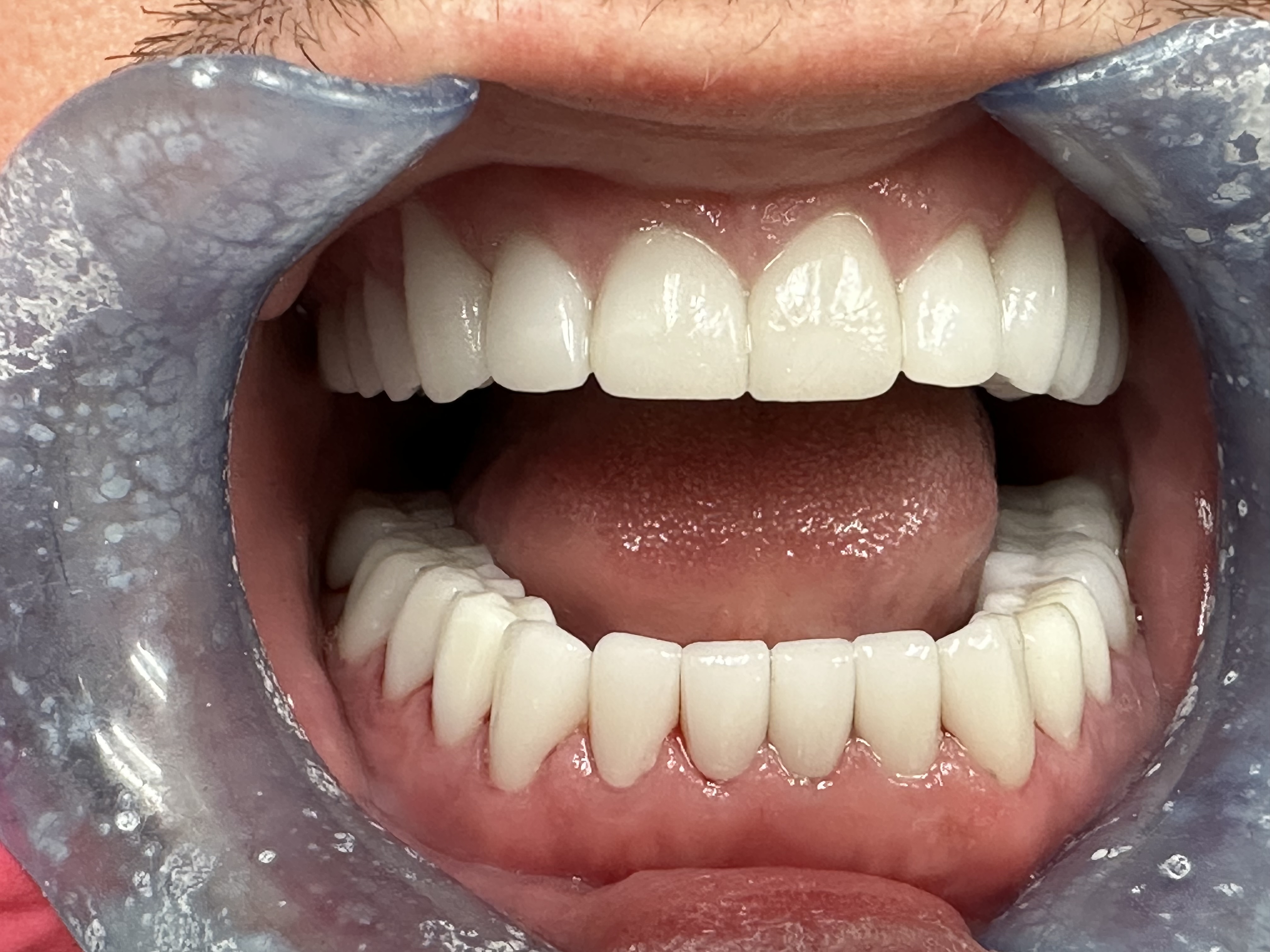 After full mouth restoration